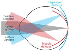 Getting Up Close and Personal with Myopia